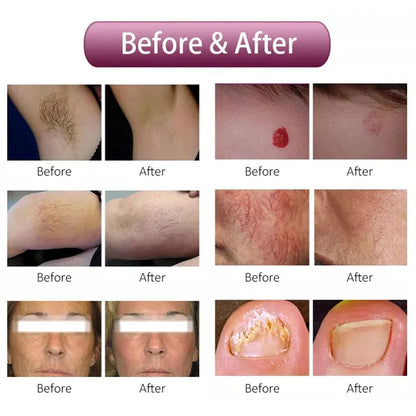 High quality 1064nm painless hair removal Clinic 755NM alexandrite machine